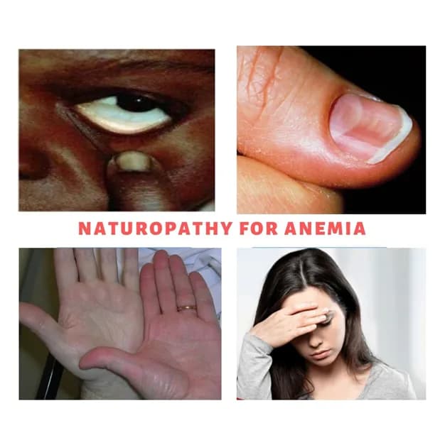 Anemia (Hemoglobin
level not less than
8gm/100ml)